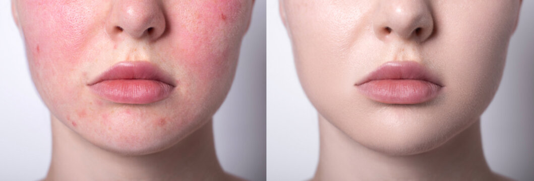 Skin Redness