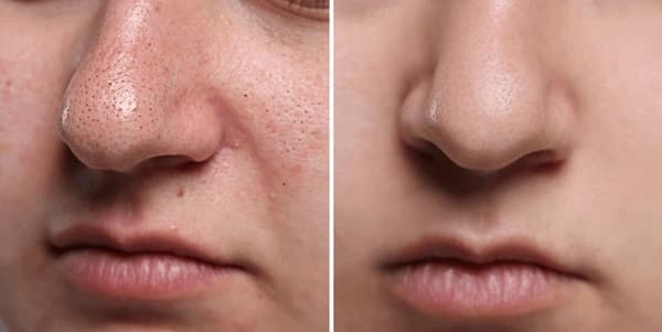 Before and after blackhead removal
