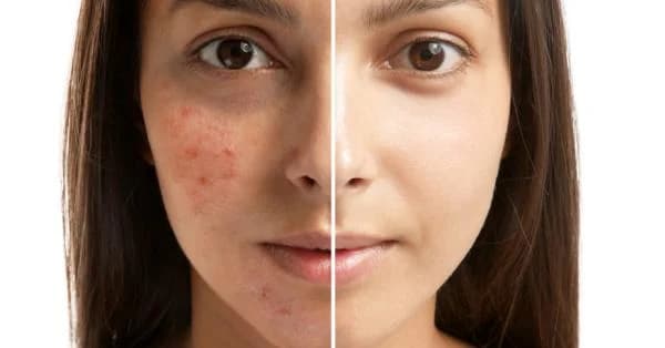 Before and after dark spots treatment