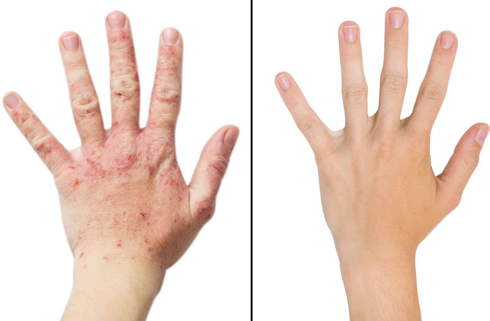 Before and after eczema treatment