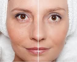 Before and after skin firming