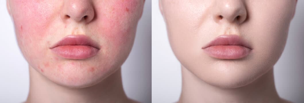 Before and after redness reduction